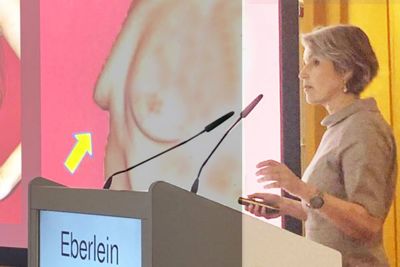 DR. EBERLEIN BERICHTET ÜBER ANATOMISCHE BRUSTIMPLANTATE